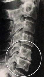 Progressive Degenerative Changes