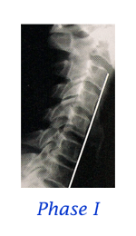 Loss of Normal Curve