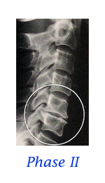 Progressive Degenerative Changes